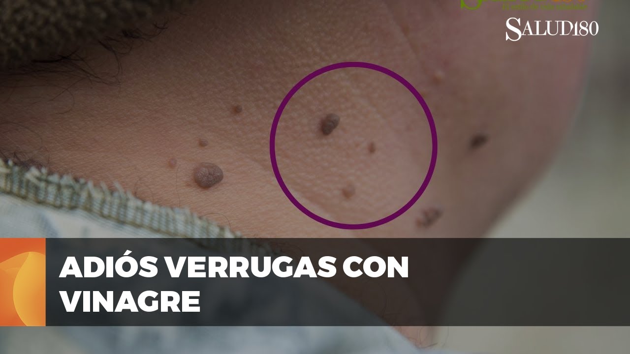 como quitar verrugas de forma natural