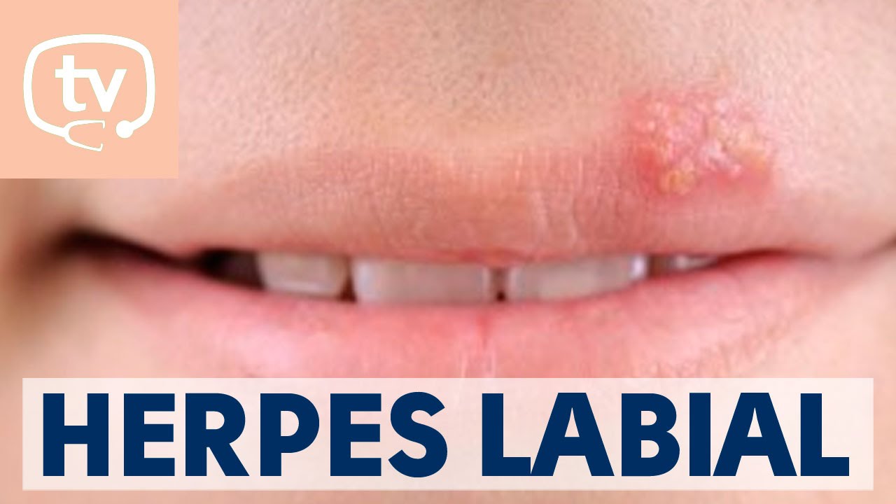 cuanto tarda en quitarse un herpes labial