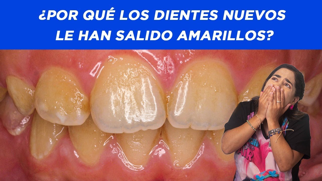 porque los dientes nuevos salen amarillos