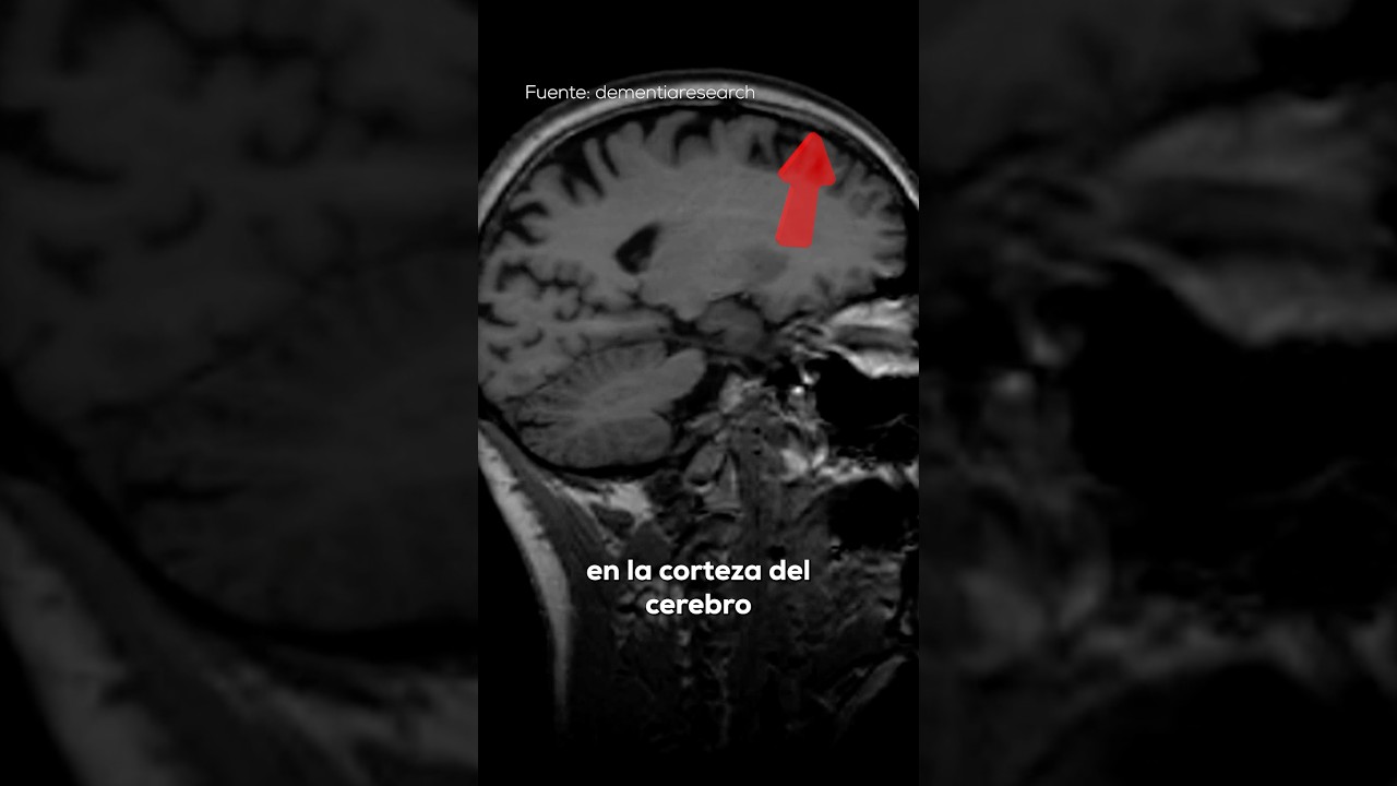 atrofia cortico subcortical en relación con la edad