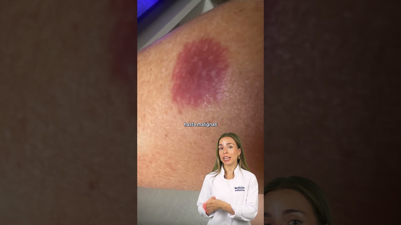 mancha roja en la cabeza adulto