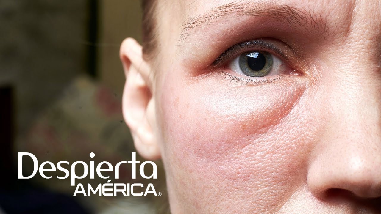 me levanto con la cara hinchada