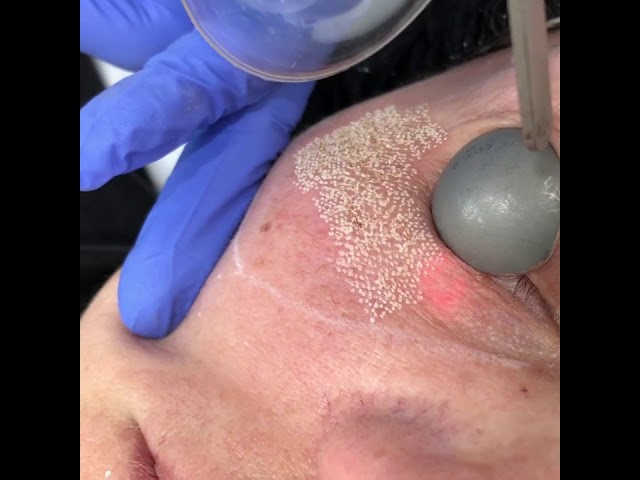 quitar patas de gallo con láser