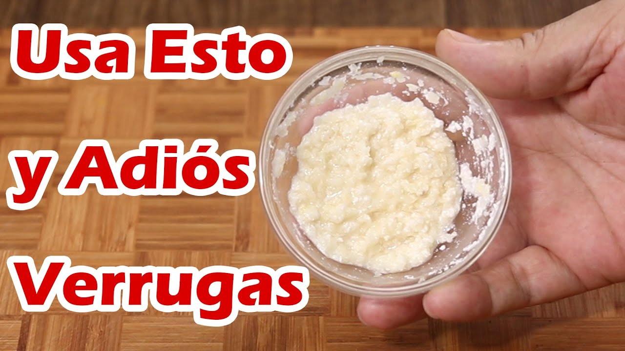 remedios caseros para quitar las verrugas