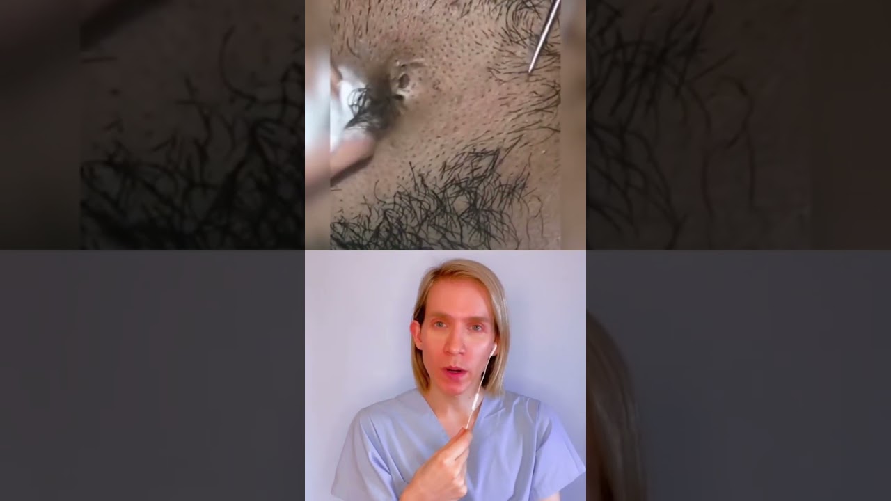 como se ve un pelo encarnado