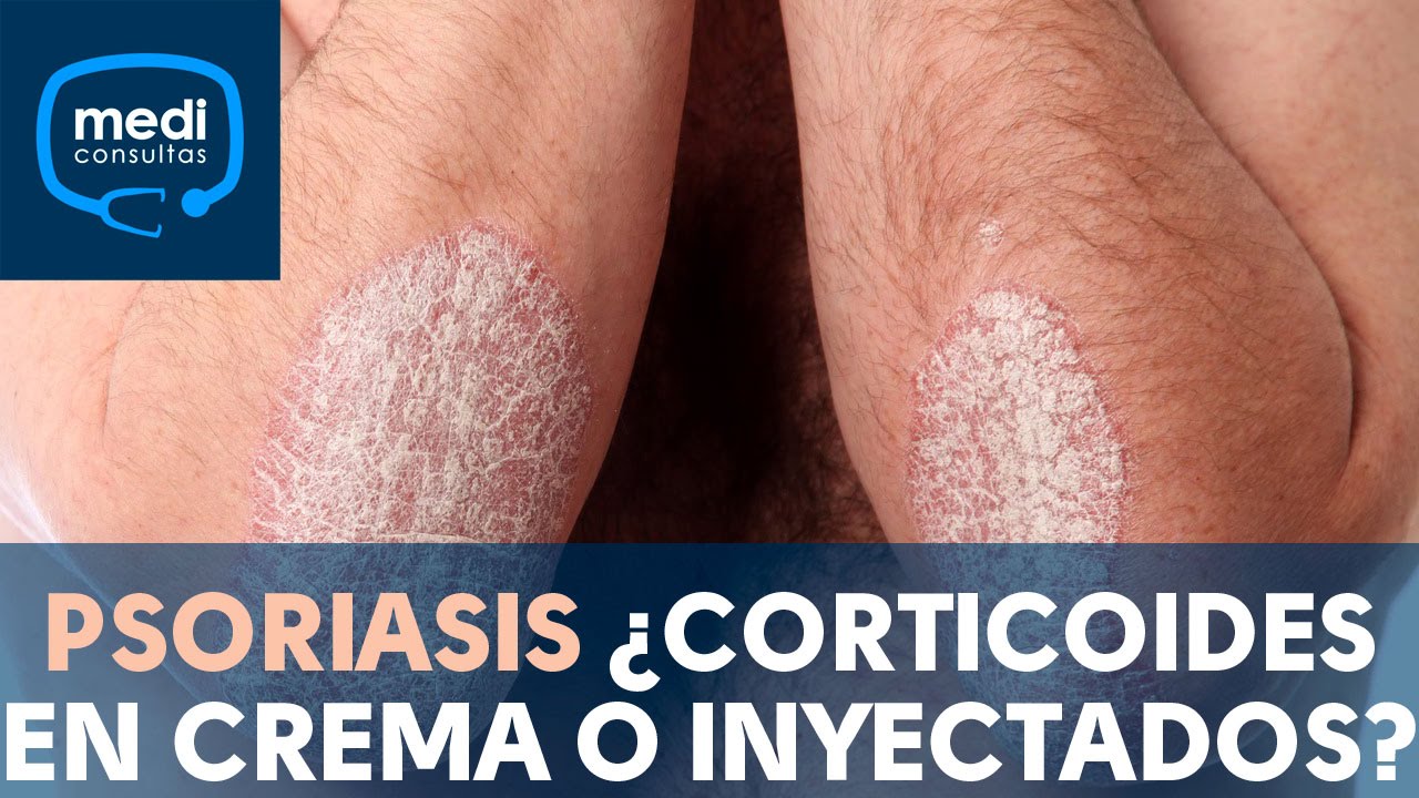 crema para la psoriasis con corticoides