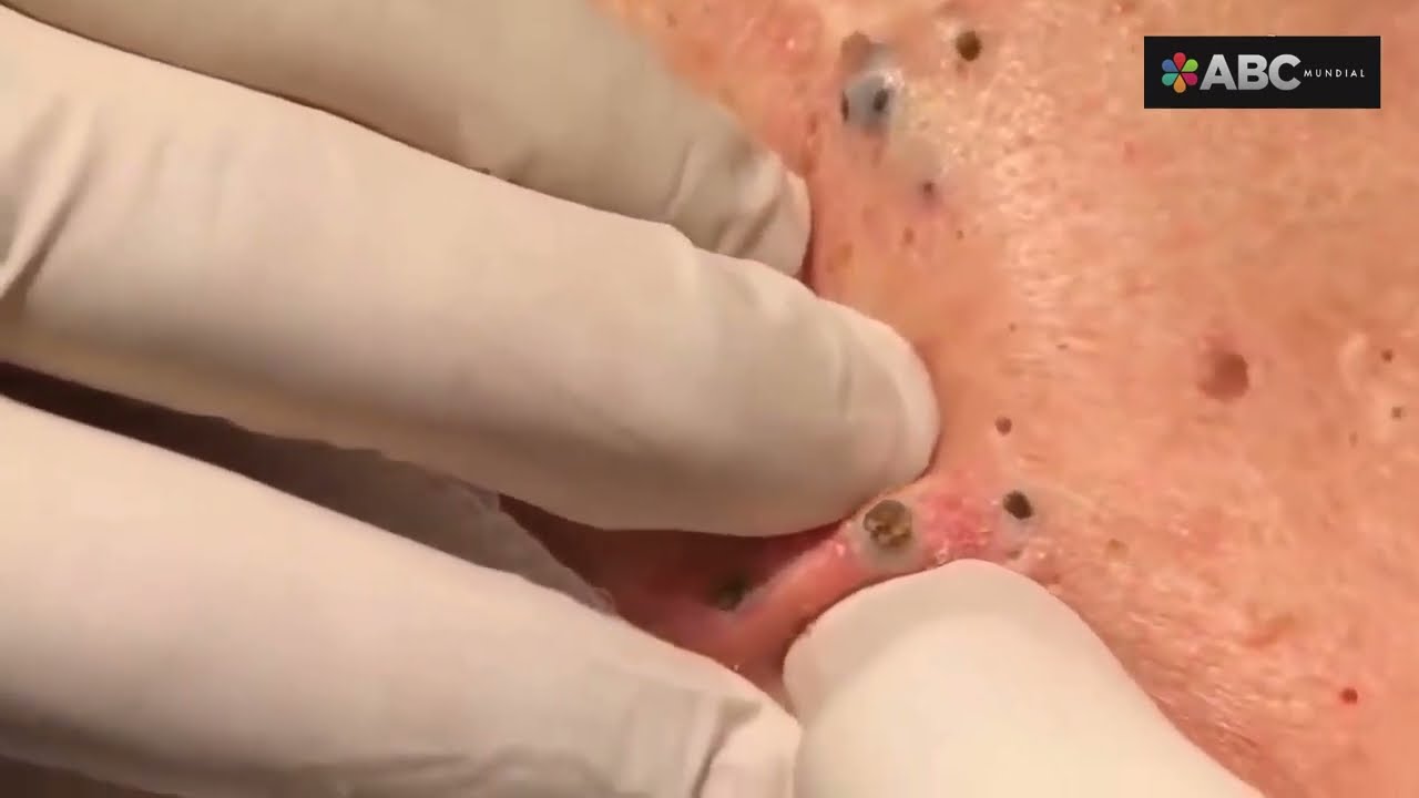 espinillas y puntos negro en la cara