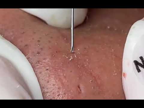 extracción puntos negros en la nariz