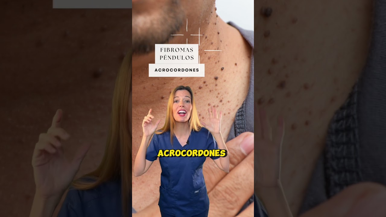 líquido para quitar verrugas del cuello