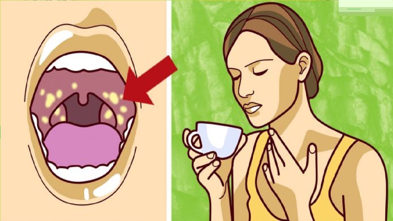 llaga en la garganta como curar