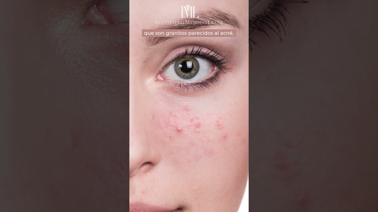 manchas rojas en la piel con relieve