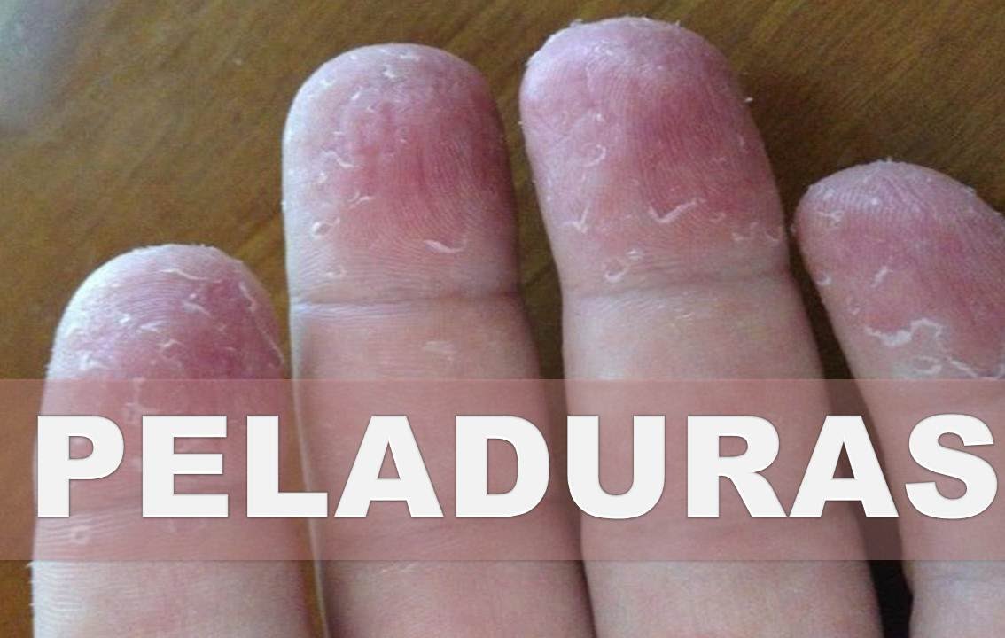 pellejos en los dedos de las manos