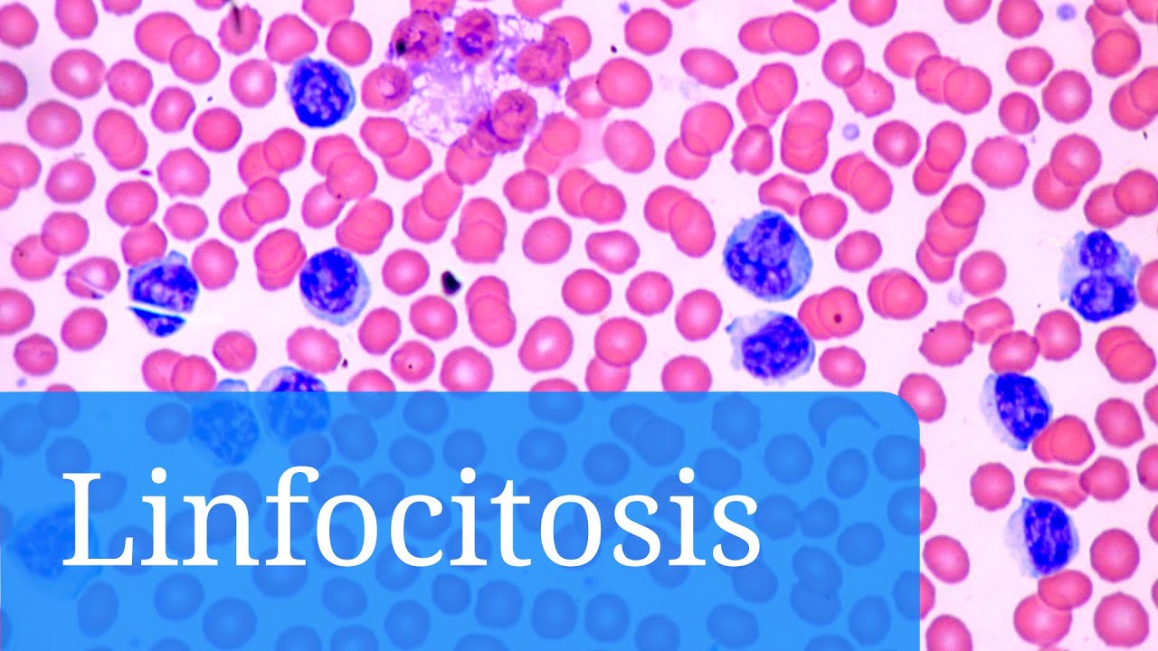 que pasa si tienes los linfocitos altos