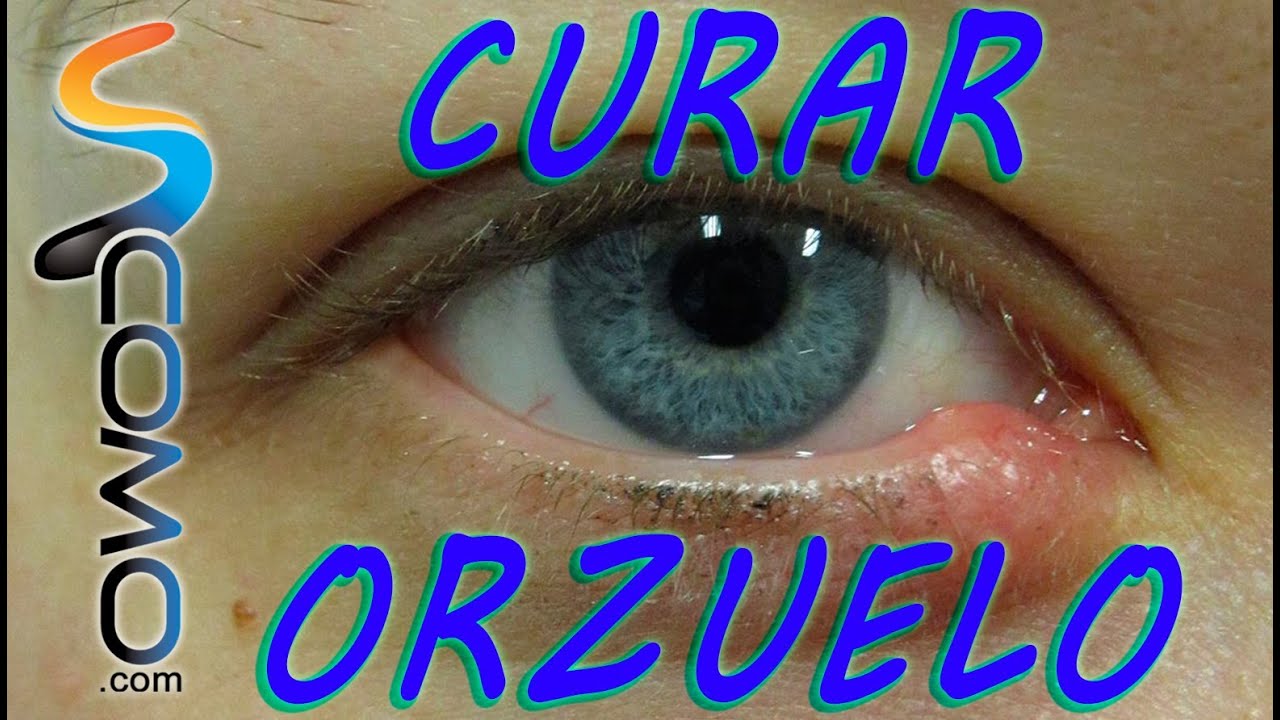 remedios caseros para orzuelos en el ojo