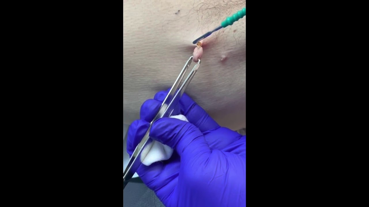 tipos de verrugas en el cuero cabelludo