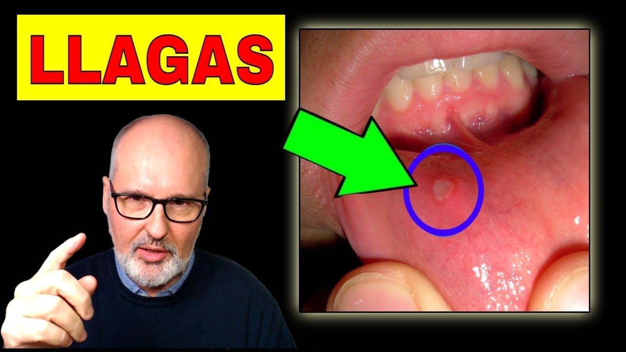 como curar una llaga en el labio