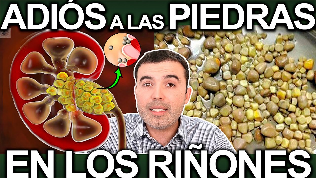 como se expulsan las piedras del riñon