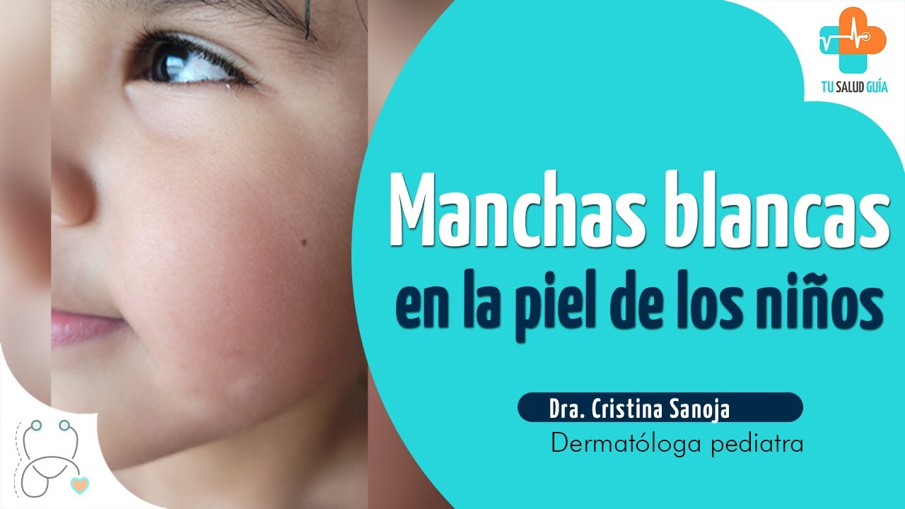 manchas blancas en la cara en niños tratamiento natural